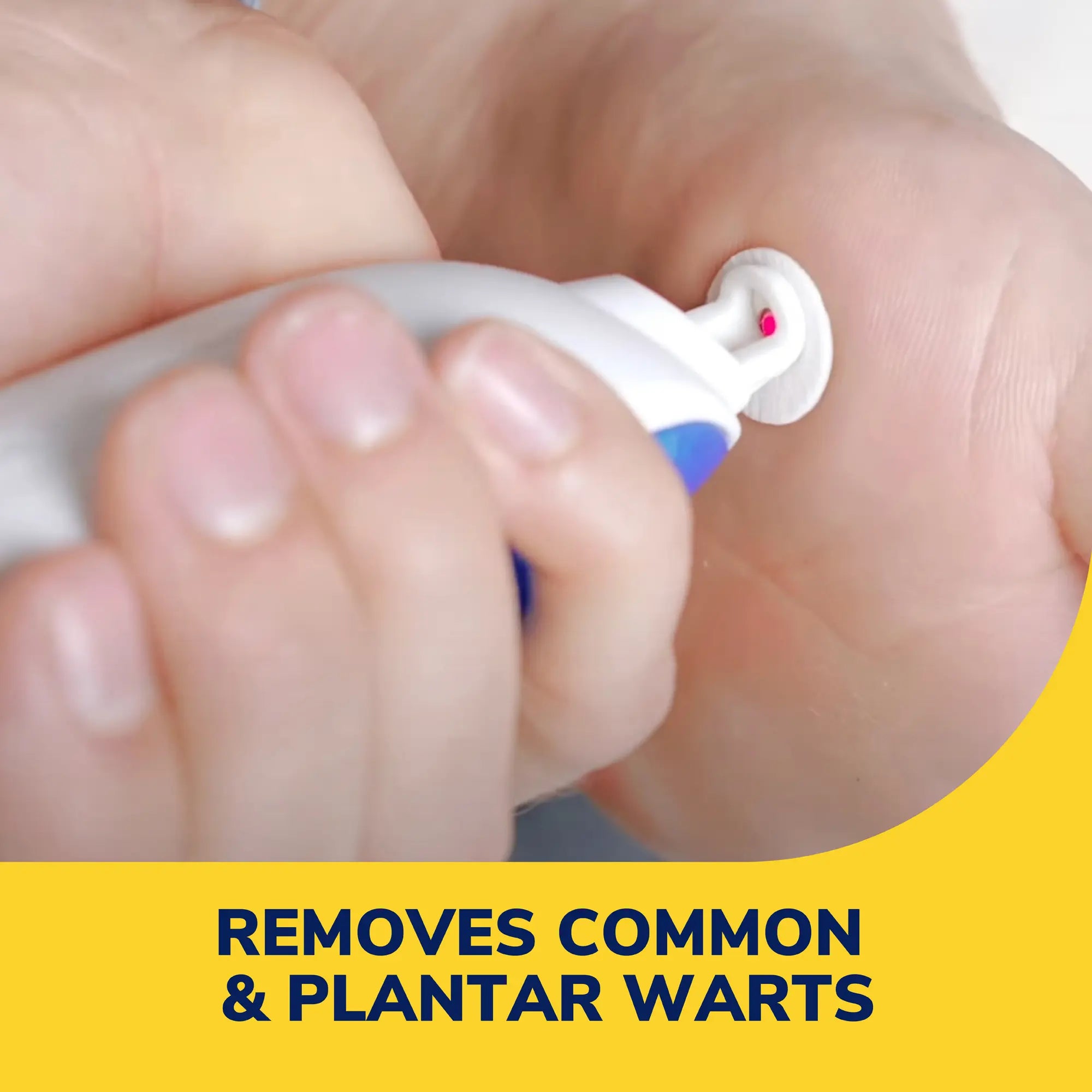 Freeze Away Max™ Wart Remover - Image 2