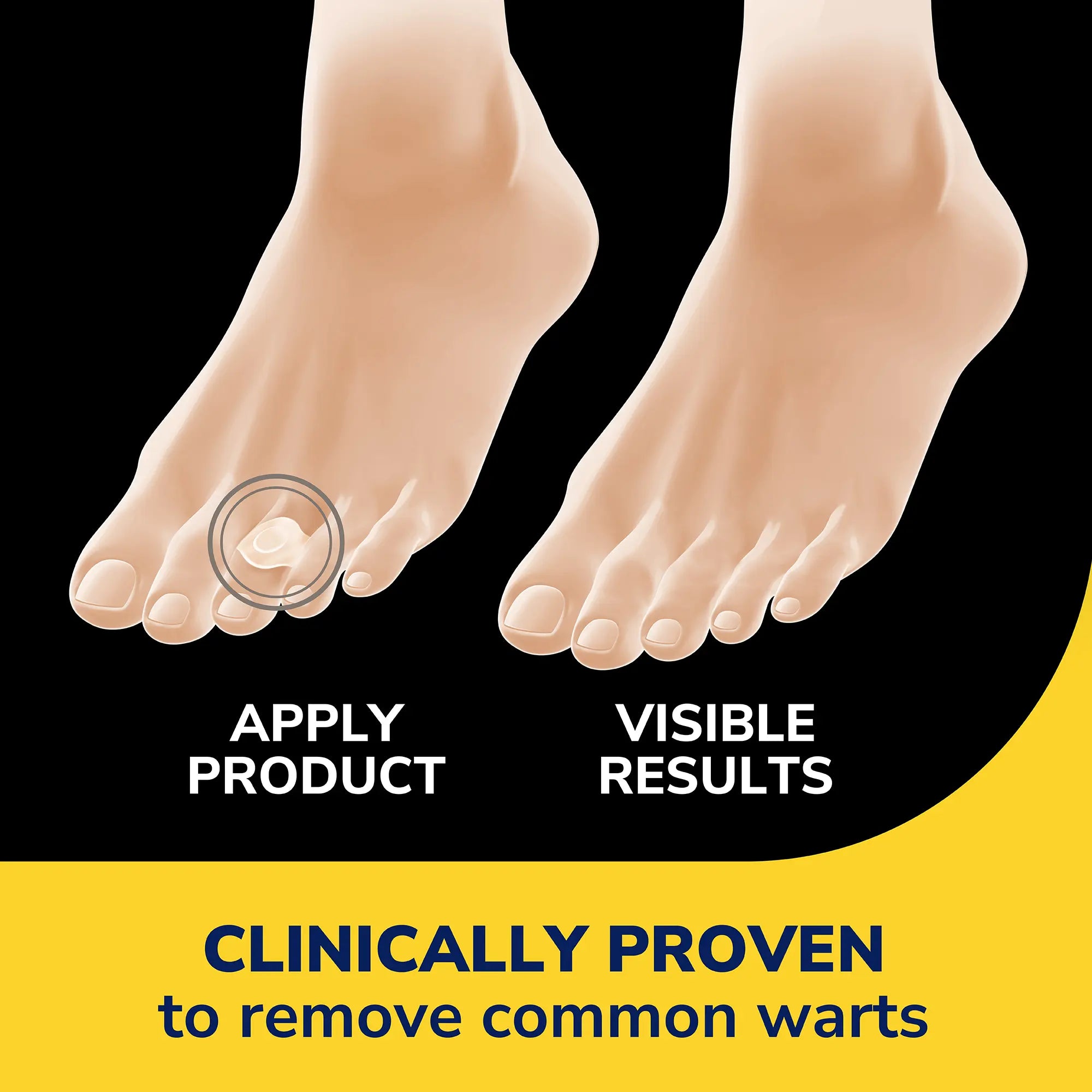 Clear Away® Wart Removers Seal & Heal Bandage with Hydrogel Technology - Image 3