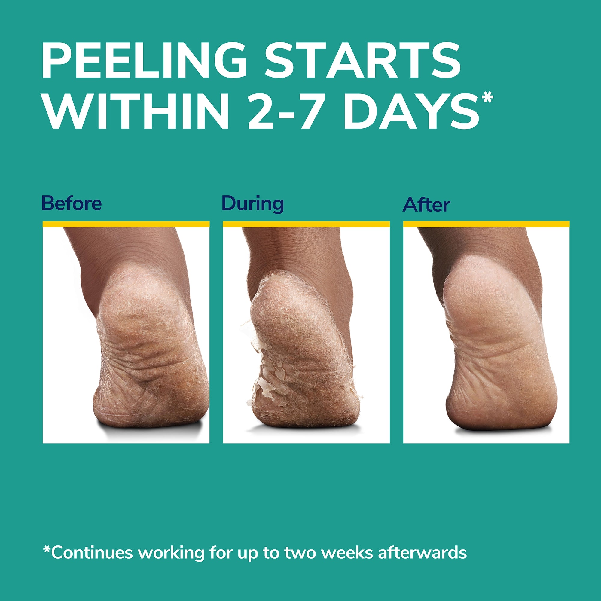 Rough, Dry Skin Ultra-Exfoliating Foot Mask - Image 5