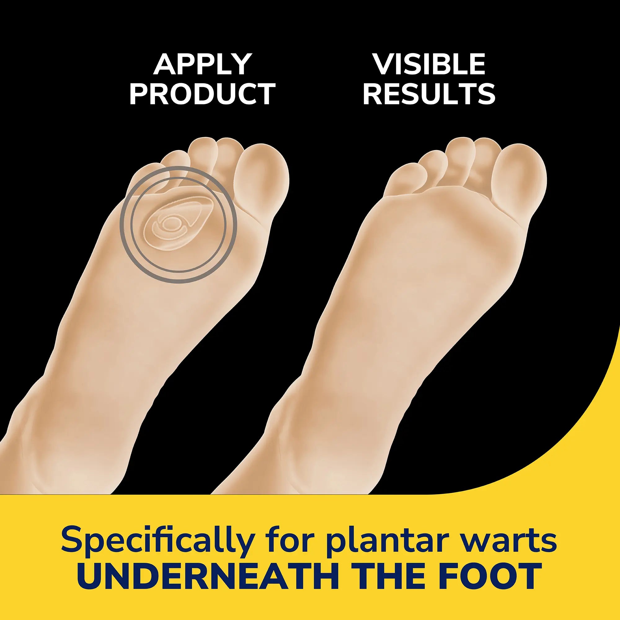 Plantar Wart Remover Seal & Heal Bandage with Hydrogel Technology - Image 3